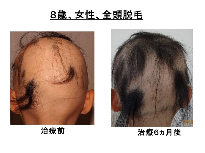 円形脱毛症　病院